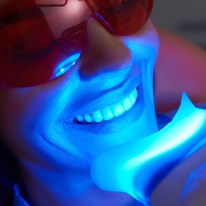 blanqueamiento zoom 1 Eugenia Cervantes | Clínica Dental en Madrid