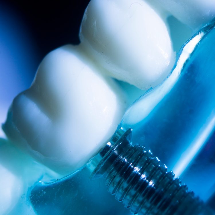 implantes madrid Eugenia Cervantes | Clínica Dental en Madrid