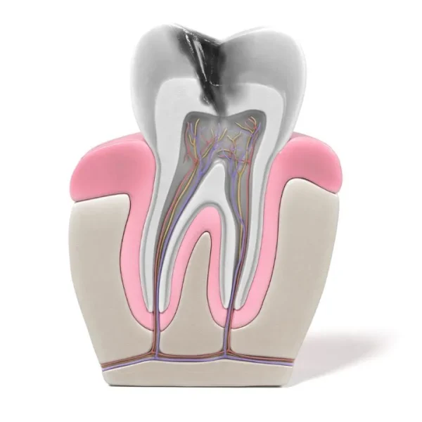 Ilustración diente caries endodoncia