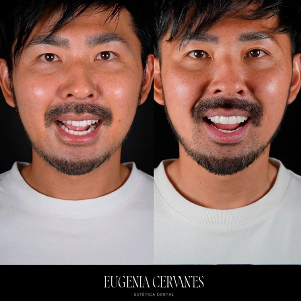 Antes después carillas composite hombre