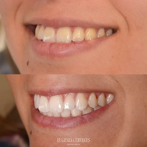 blanqueamiento dental o carillas