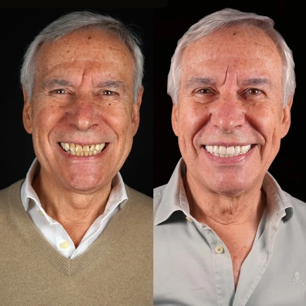 Paciente 50 años carillas dentales diseño sonrisa