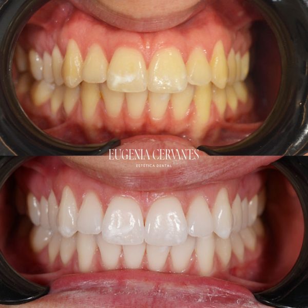 Tratamiento blanqueamiento dental