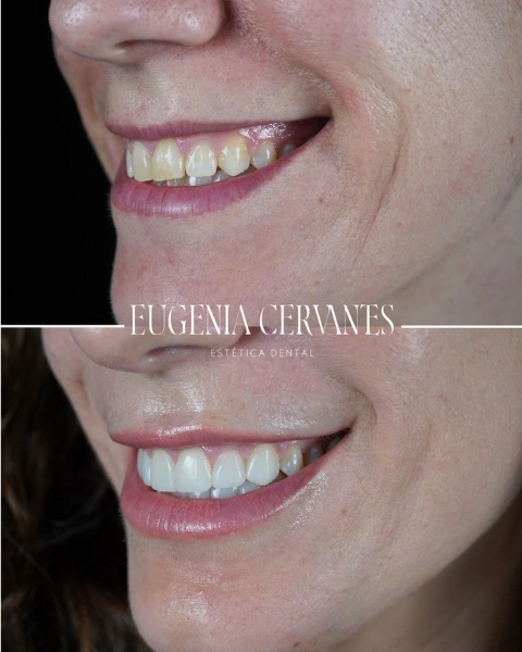 Antes y después carillas composite mujer