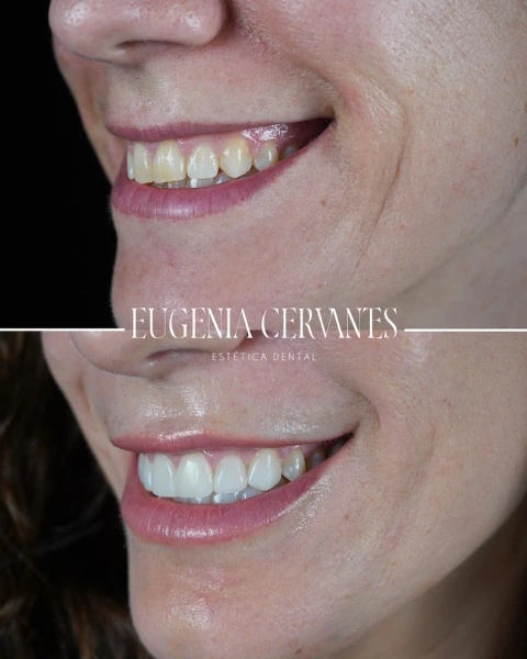 Carillas composite antes y después mujer