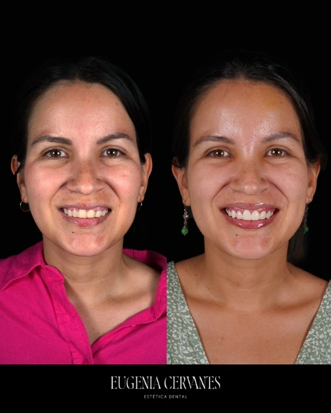 Caso mujer antes y después carillas dentales desventajas