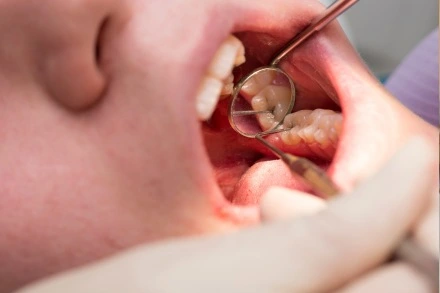 Blanqueamiento dental si tengo caries