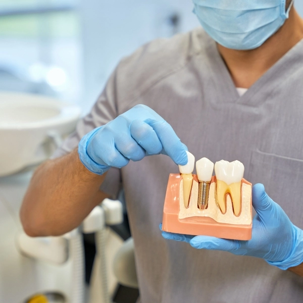 Implantes dentales