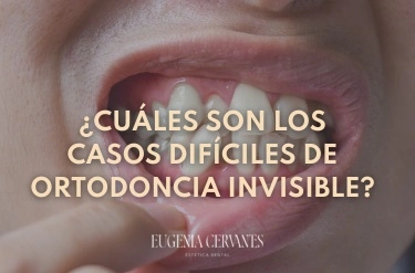 casos difíciles ortodoncia invisible dientes apiñados