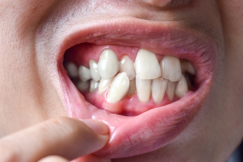 casos difíciles ortodoncia invisible