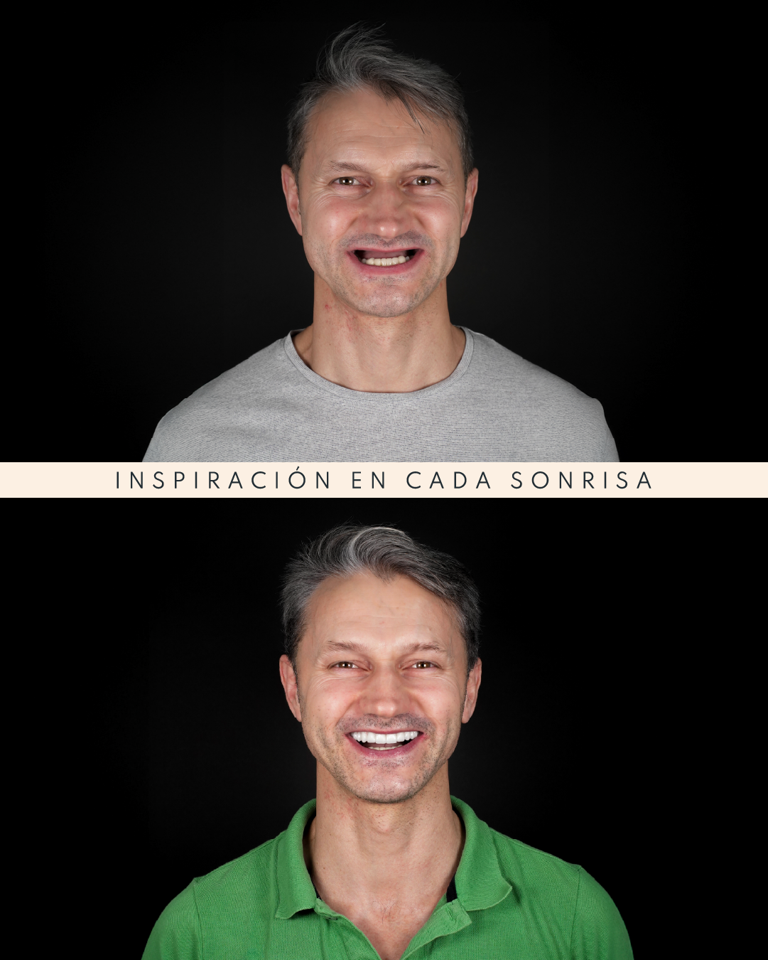 Antes y Despues Alex Baranovskyy Eugenia Cervantes | Clínica Dental en Madrid
