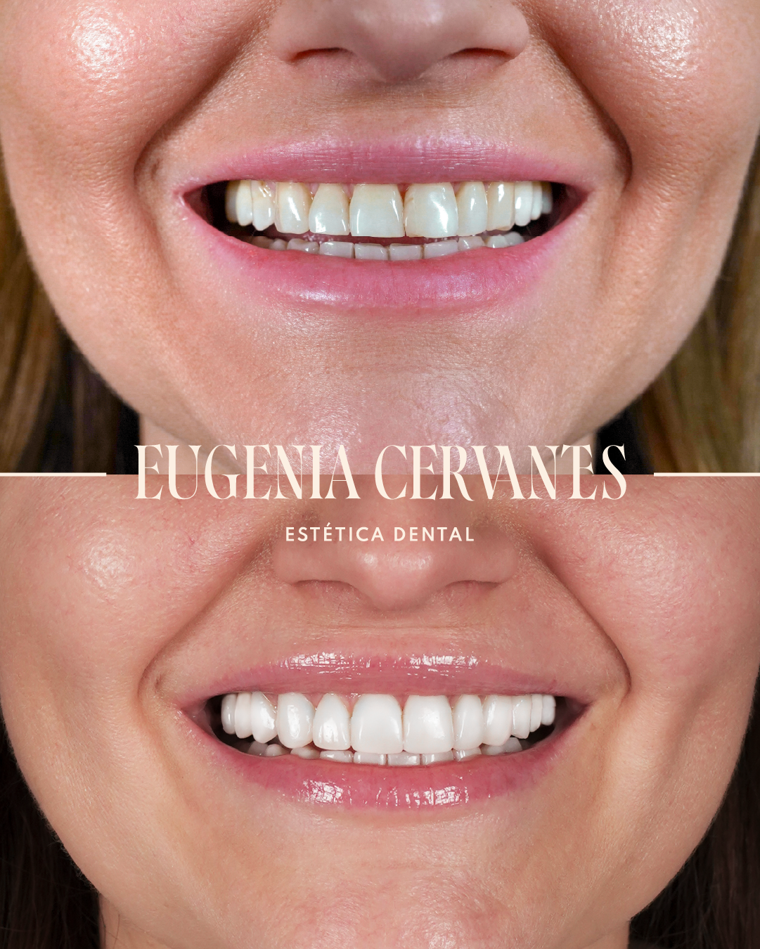 NUEVO 3 Antes y Despues Rodica Zamfir Eugenia Cervantes | Clínica Dental en Madrid