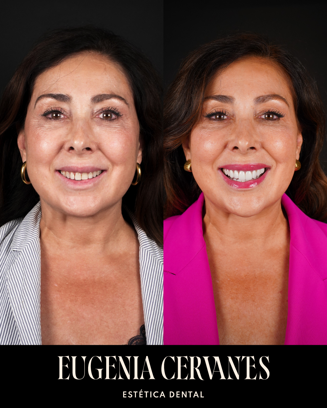 Antes y Despues Maria Jose Perez CARA Eugenia Cervantes | Clínica Dental en Madrid