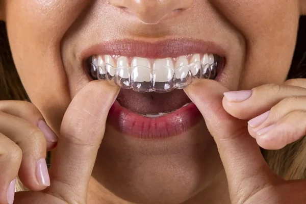 ortodoncia invisible en Madrid 600x400 1 Eugenia Cervantes | Clínica Dental en Madrid